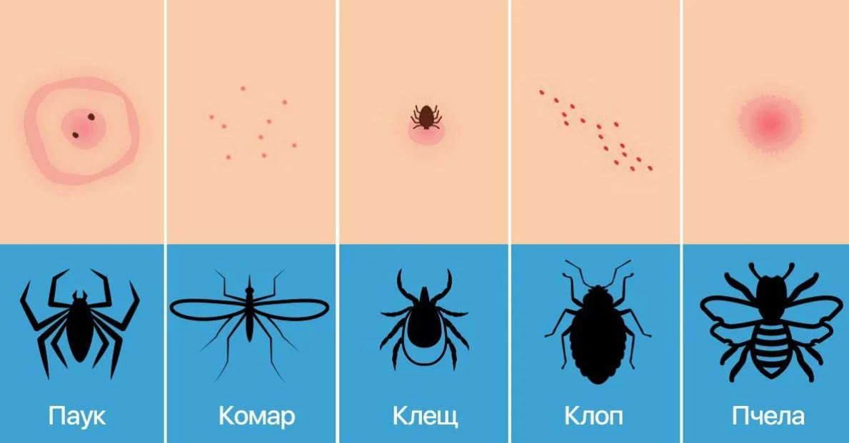 Как отличить укусы постельных клопов от укусов других насекомых?